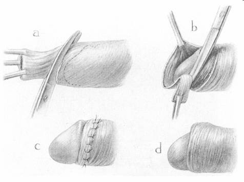 Scissors method of Sir Fredeerick Treves