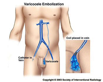 Varicocoele image showing circumcised penis