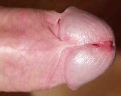 Intact penis with skin bridge