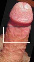 Penis with skin bridge on shaft