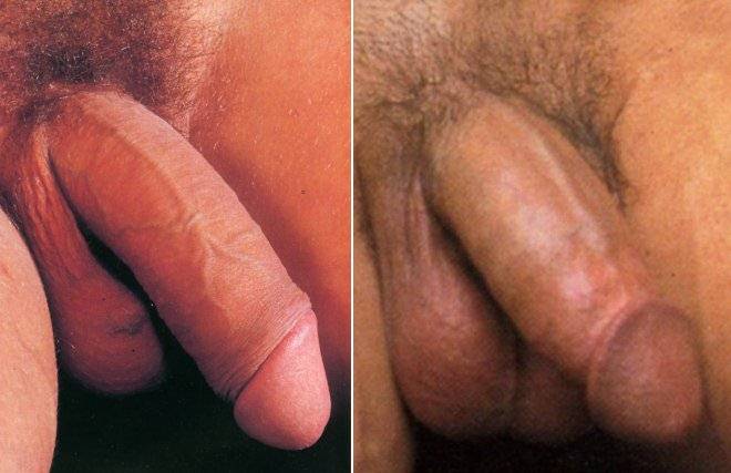 Adult circumcision pictures