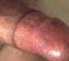 Circumcised penis showing Plastibell ring scar
