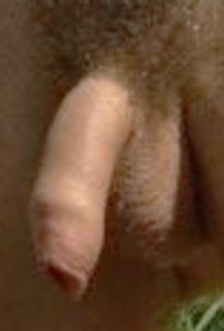 A tighter foreskin