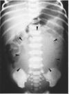 X-ray of swollen bladder (thumbnail)