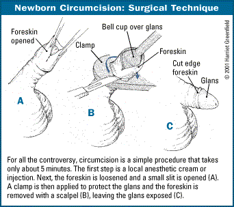 Newborn Circumcision: Surgical Technique