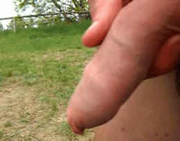 Real foreskin being retracted