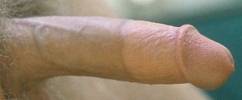 Circumcised penis showing blocked veins